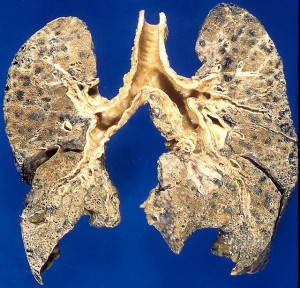 Emphysema-damaged lungs caused by smoking Photo credit: Yale Rosen